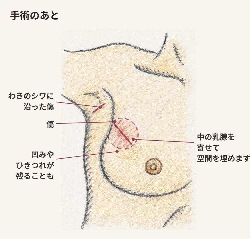手術のあと。胸の小さな傷と、わきのシワに沿った傷、取ったあとの空間を乳腺で埋めた様子が描かれた図