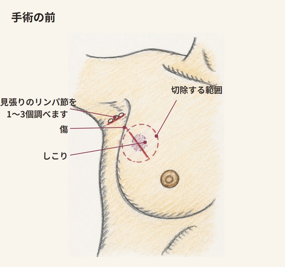手術の前。しこりを囲む切除する範囲と、その上を斜めに走る短い切開線、わきにも小さな傷が描かれた図